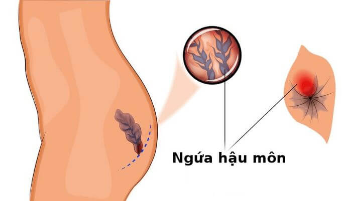 biểu hiện của bệnh trĩ giai đoạn đầu