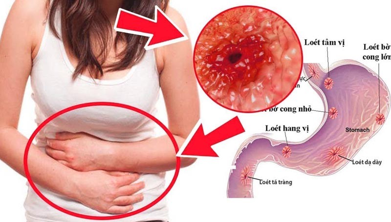 Thuoc Chua Dau Da Day 7 Ngay