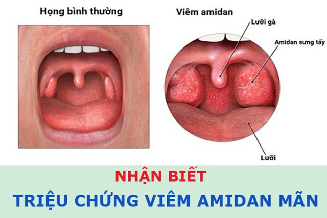 7 Triệu Chứng Viêm Amidan Phổ Biến Nhất 2020 Biết Càng Sớm Càng Tốt