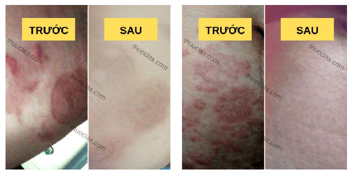 NHỮNG ĐỐI TƯỢNG PHÙ HỢP DÙNG THUỐC LAX