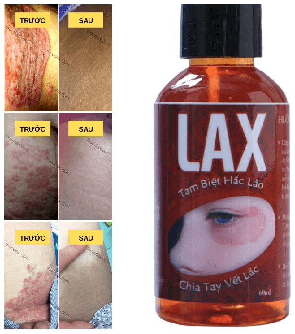 VÌ SAO TRỊ HẮC LÀO BAO NĂM KHÔNG KHỎI NHƯNG DÙNG LAX LẠI HẾT?