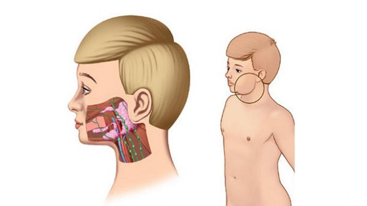 Quai bị là gì? Biến chứng nguy hiểm của bệnh quai bị mà bạn cần biết Phòng biến chứng nguy hiểm của bệnh Quai bị