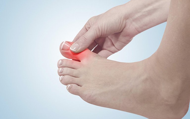 Bệnh Gout là gì? Những vấn đề liên quan đến bệnh Gout Bệnh Gout là gì? Những vấn đề liên quan đến bệnh Gout