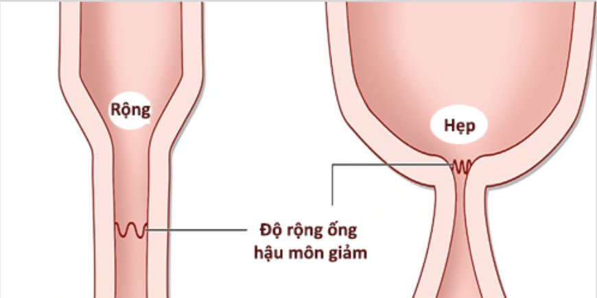 Những điều bạn chưa biết về nong hậu môn cho trẻ sơ sinh