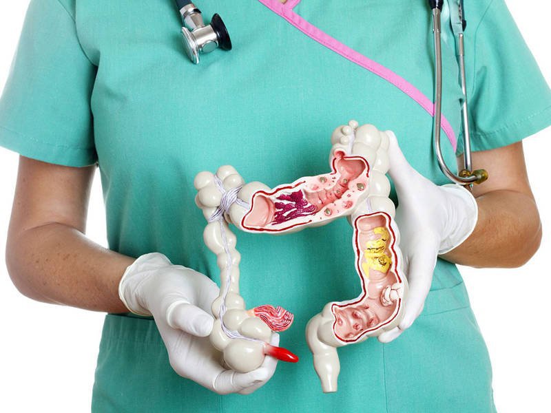 Polyp đại tràng là gì? Những ai mắc polyp đại tràng Polyp đại tràng