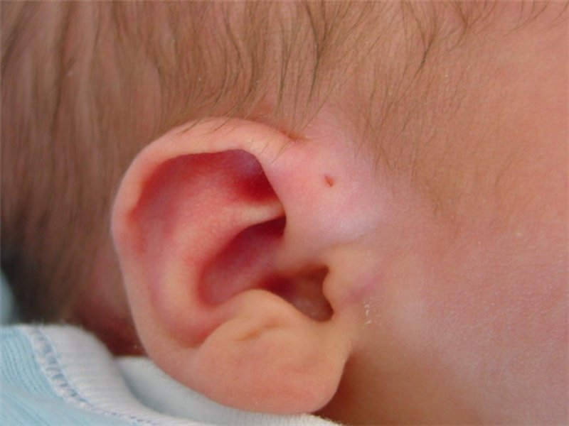 Triệu chứng và cách chữa bệnh rò luân nhĩ Triệu chứng và cách chữa bệnh rò luân nhĩ