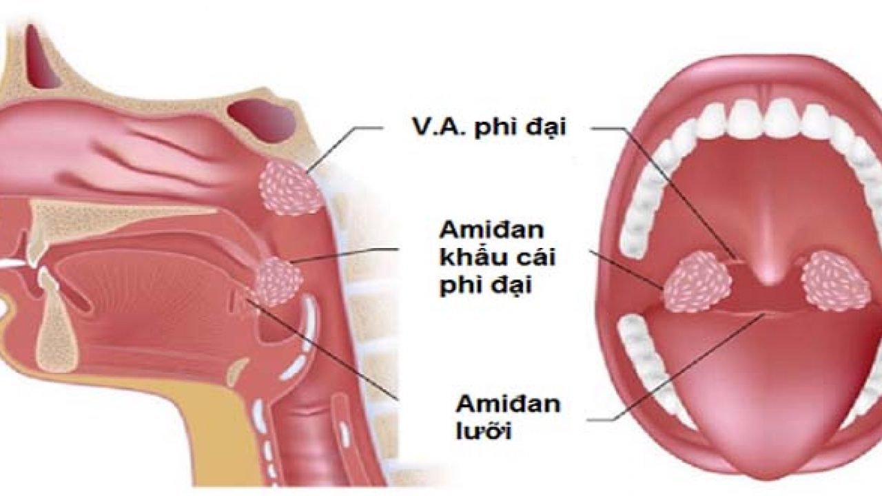 Phẫu thuật nội soi nạo VA bằng dao plasma cho trẻ có nguy hiểm không