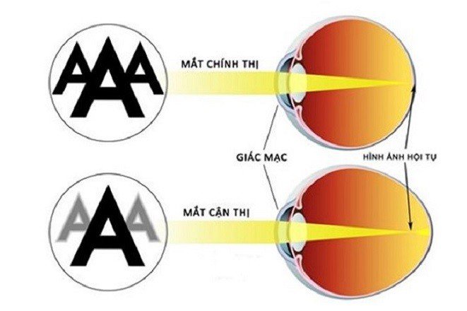 Bệnh khúc xạ là gì? Bệnh khúc xạ ở trẻ Do sự bất thường của hệ thống khúc xạ, hình ảnh của vật không được hội tụ nằm trên võng mạc mà bị hội tụ nằm trước võng mạc dẫn đến nhìn mờ