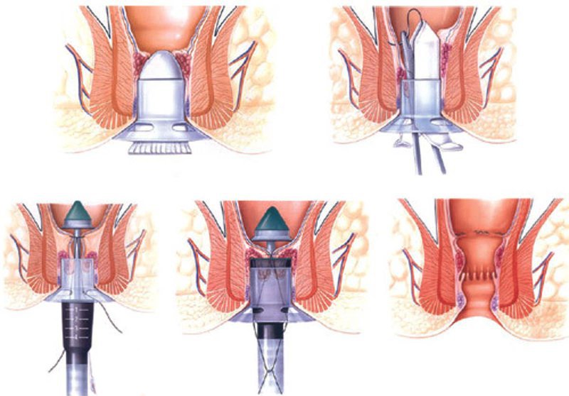 Các phương pháp điều trị trĩ Các phương pháp điều trị trĩ
