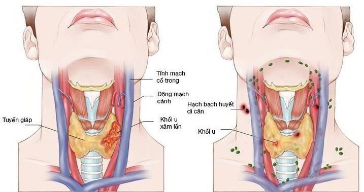 Đánh giá các triệu chứng ung thư vòm họng | Vinmec