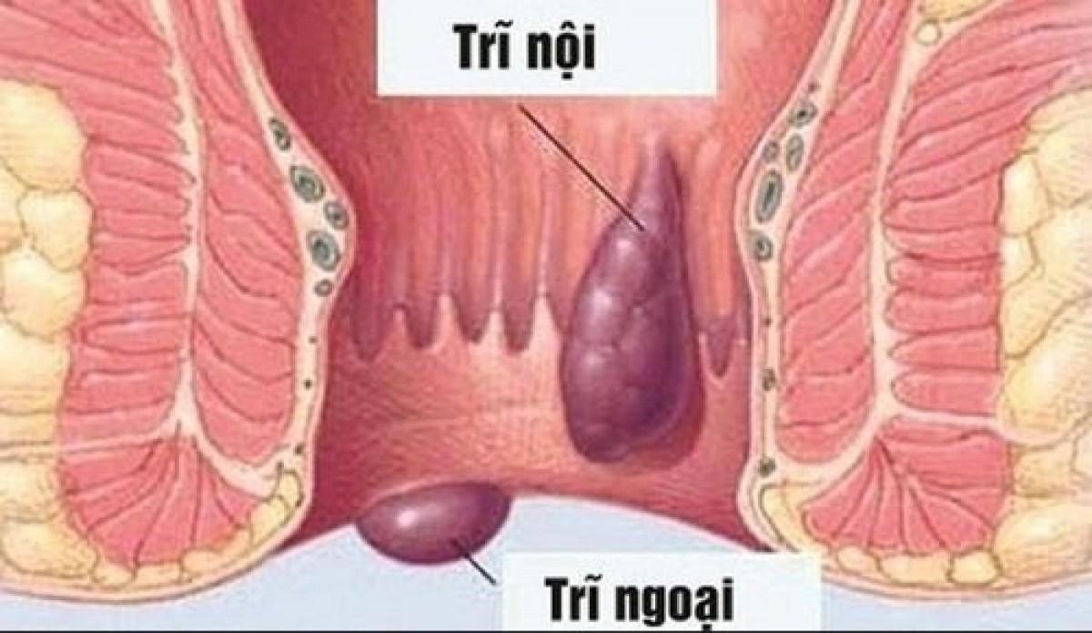 Đi khám ngay khi đi ngoài ra máu Đi khám ngay khi đi ngoài ra máu