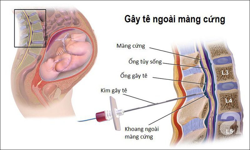 Gây tê ngoài màng cứng giảm đau sau mổ | Vinmec
