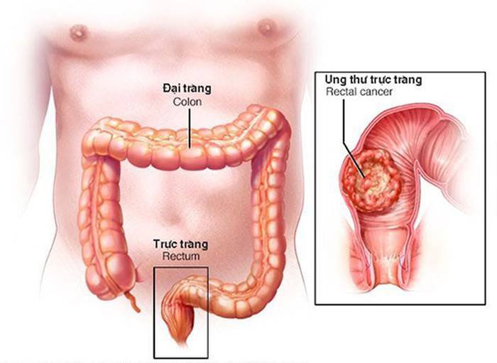 Phân biệt ung thư hậu môn và bệnh trĩ Phân biệt ung thư hậu môn và bệnh trĩ