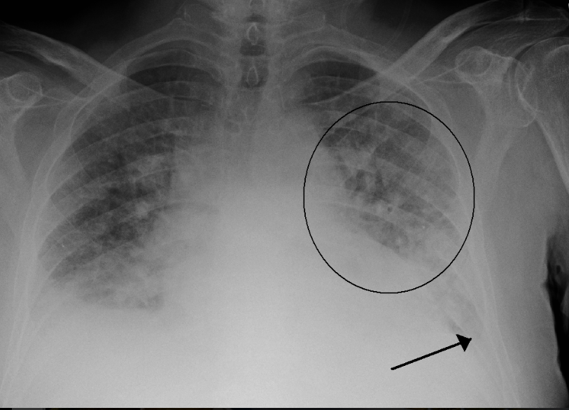 Phù phổi cấp trong thai kỳ là gì? Phù phổi cấp trong thai kỳ là gì?