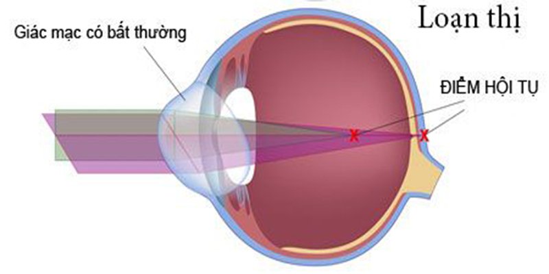 Khám phá về loạn thị nặng ở trẻ nhỏ Khám phá về loạn thị nặng ở trẻ nhỏ