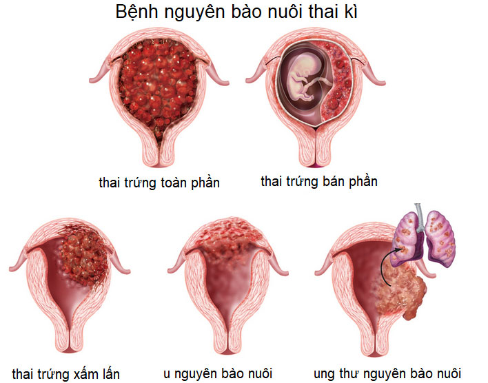 Thế nào là thai trứng? Ảnh hưởng lâu dài của chửa trứng tới sức khỏe sinh sản