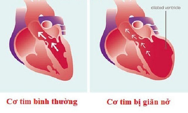 Cơ tim giãn là gì? Nguyên nhân và cách điều trị Bệnh cơ tim giãn
