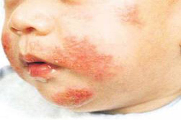 Dấu hiệu và cách phòng tránh bênh lupus ban đỏ ở trẻ sơ sinh
