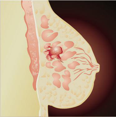 Ưu điểm và nhược điểm của chỉ số CA 15-3
