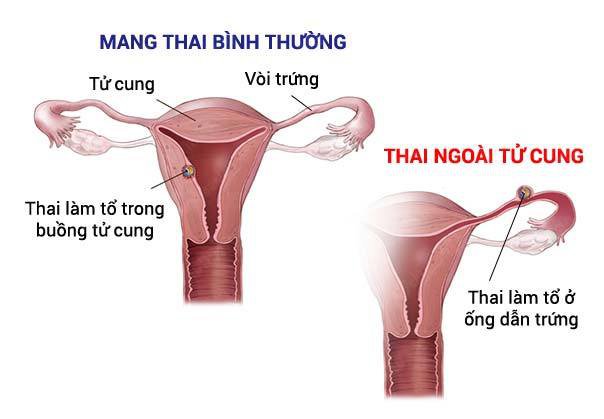 Chửa ngoài tử cung là gì? Biến chứng sau mổ thai ngoài tử cung