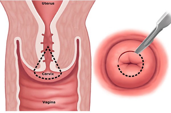 Khoét chóp cổ tử cung là gì? Nguy cơ xảy ra sau khoét chóp cổ tử cung