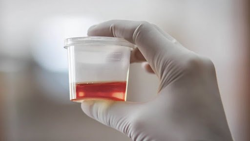 Triệu chứng và cách phòng ngừa tiểu máu ở trẻ em Triệu chứng và cách phòng ngừa tiểu máu ở trẻ em