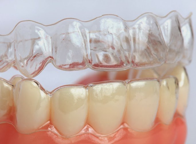 Cách phương pháp chỉnh nha mới nhất bạn nên biết Các phương pháp chỉnh nha hiện đại
