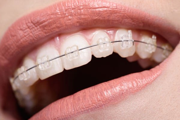 Cách phương pháp chỉnh nha mới nhất bạn nên biết Các phương pháp chỉnh nha hiện đại