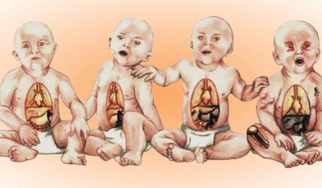 Triệu chứng và cách chữa trị u nguyên bào thần kinh Triệu chứng và cách chữa trị u nguyên bào thần kinh