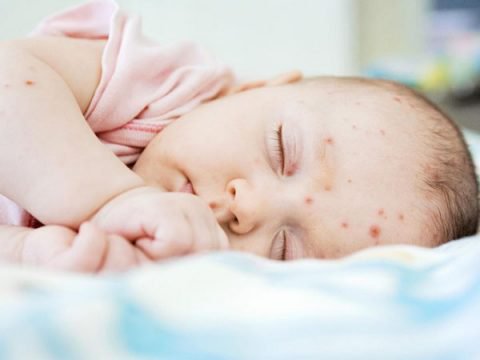 Thường sau khi sốt cao 3 – 4 ngày trẻ bắt đầu phát ban