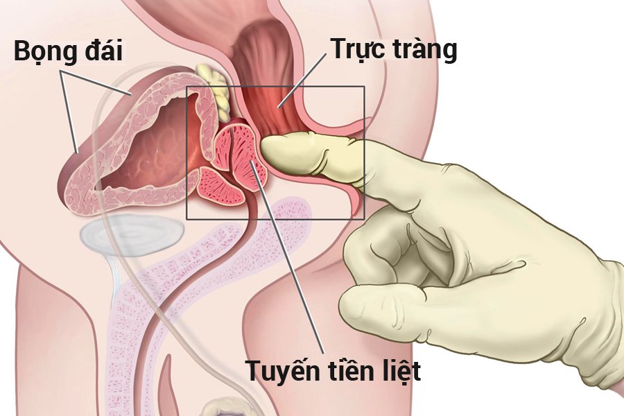 Chỉ số PSA và fPSA trong chẩn đoán ung thư tiền liệt tuyến Chỉ số PSA và fPSA trong chẩn đoán ung thư tiền liệt tuyến