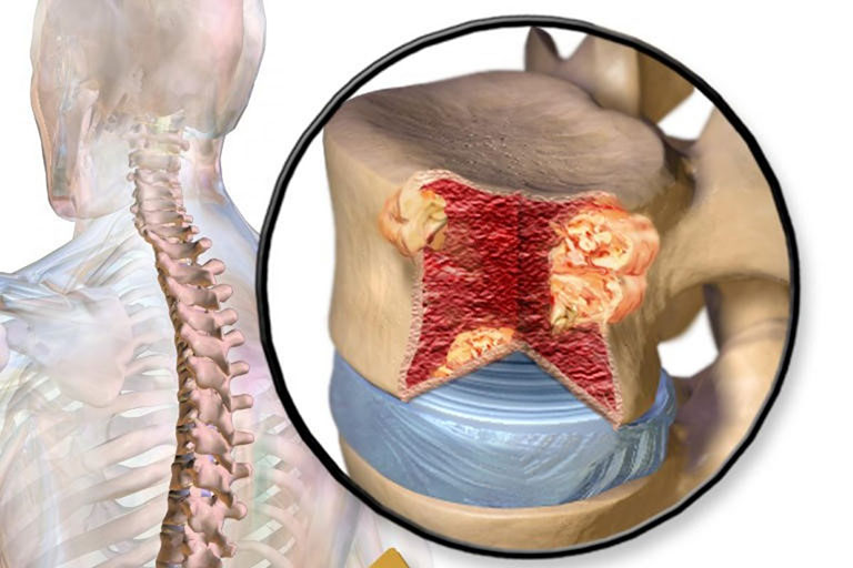 Triệu chứng và cách phòng tránh đau tủy xương