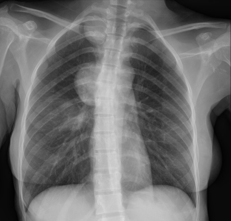 Cách điều trị u trùng thất theo hướng dẫn của bác sĩ