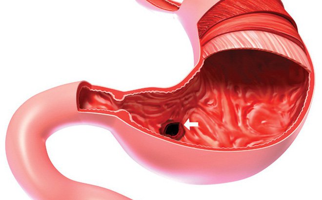 Triệu chứng và cách phòng ngừa viêm dạ dày thứ phát Triệu chứng và cách phòng ngừa viêm dạ dày thứ phát