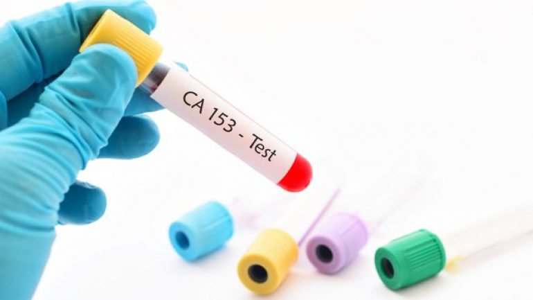 CA 15-3: Dấu ấn ung thư vú có ý nghĩa như thế nào? CA 15-3: Dấu ấn ung thư vú có ý nghĩa như thế nào?