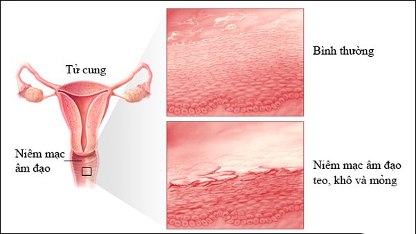 Teo âm đạo: Những điều cần biết