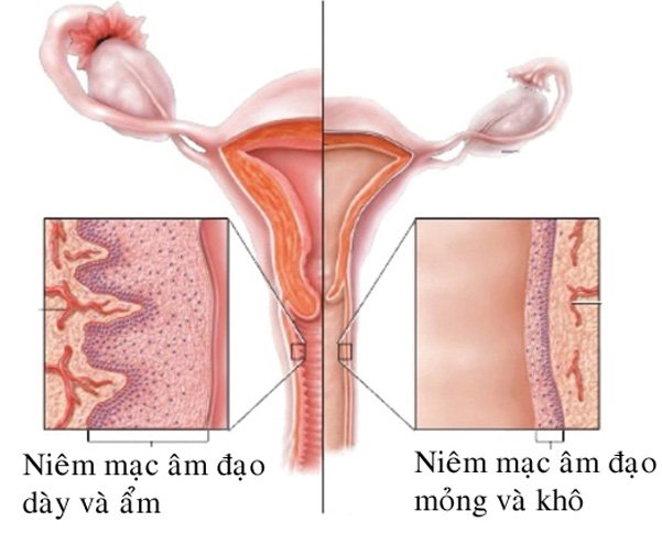 Teo âm đạo: Những điều cần biết