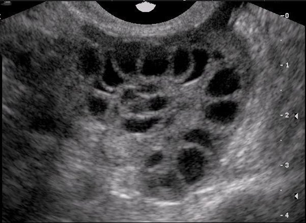 Hội chứng quá kích buồng trứng là gì?