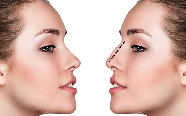 Những điều cần biết về phẫu thuật thẩm mỹ mũi | VTV.VN