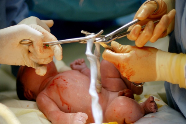 Kẹp cắt dây rốn chậm là gì? Lợi ích không ngờ từ kẹp cắt dây rốn chậm sau sinh Kẹp cắt dây rốn chậm là gì? Lợi ích không ngờ từ kẹp cắt dây rốn chậm sau sinh