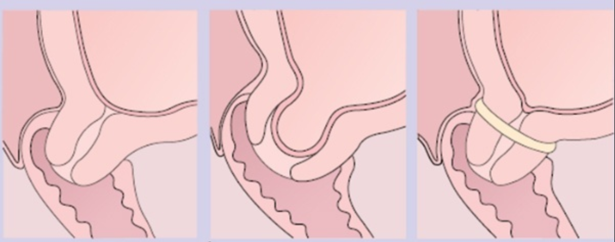 Khâu vòng thu hẹp lỗ cổ tử cung là gì? Tai biến có thể gặp sau khâu vòng cổ tử cung