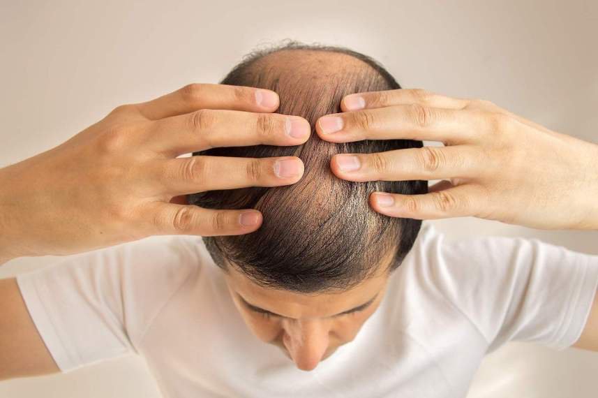 Phương pháp mọc tóc sau hoá trị ung thư Phương pháp mọc tóc sau hoá trị ung thư