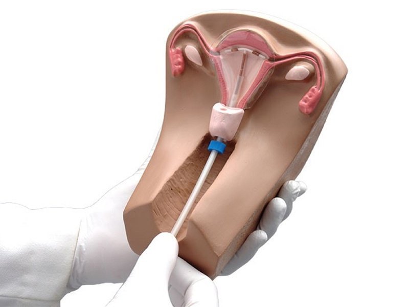 Điều trị ung thư cổ tử cung giai đoạn sớm bằng kỹ thuật khoét chóp bằng vòng điện