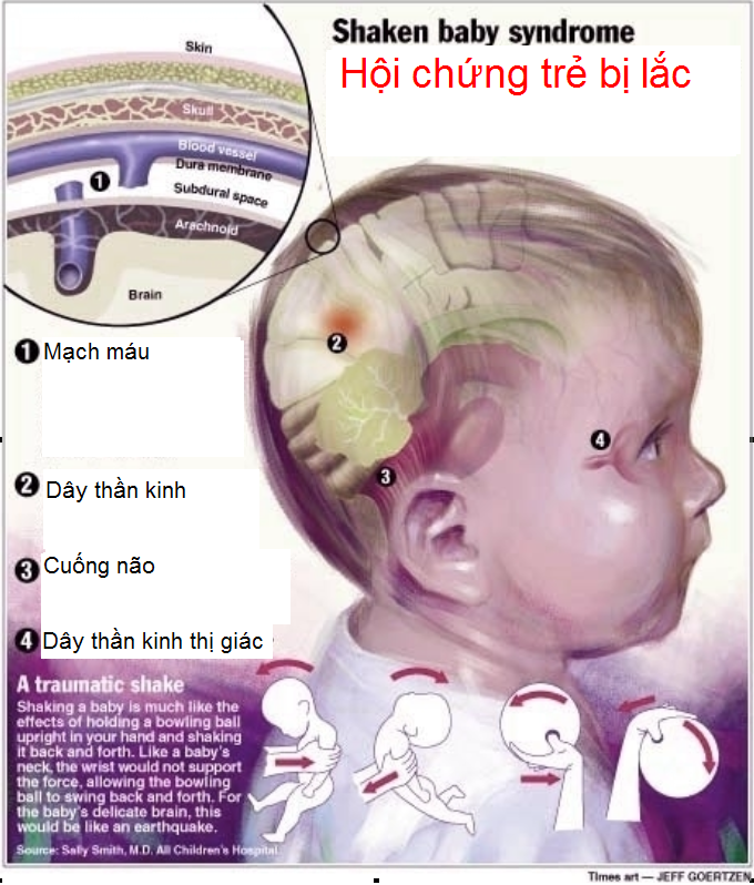 Hội chứng rung lắc ở trẻ em và các tác hại bạn cần phải biết