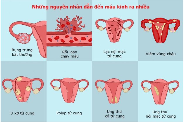 Thế nào là kinh nguyệt ra nhiều? Kinh nguyệt ra nhiều có nguy hiểm không? Thế nào là kinh nguyệt ra nhiều? Kinh nguyệt ra nhiều có nguy hiểm không?