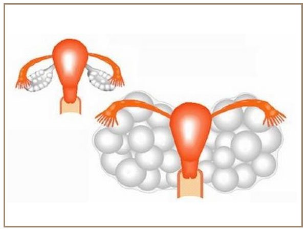 Hội chứng quá kích buồng trứng là gì? Điều trị như thế nào?