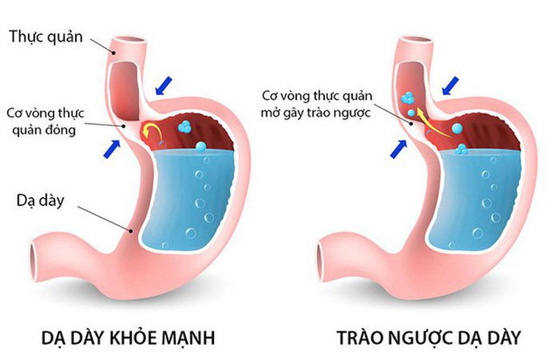 Luồng trào ngược dạ dày thực quản ở trẻ em