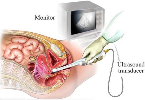 Siêu âm đầu dò âm đạo là gì? Những lưu ý khi siêu âm đầu dò âm đạo Siêu âm đầu dò âm đạo là gì? Những lưu ý khi siêu âm đầu dò âm đạo