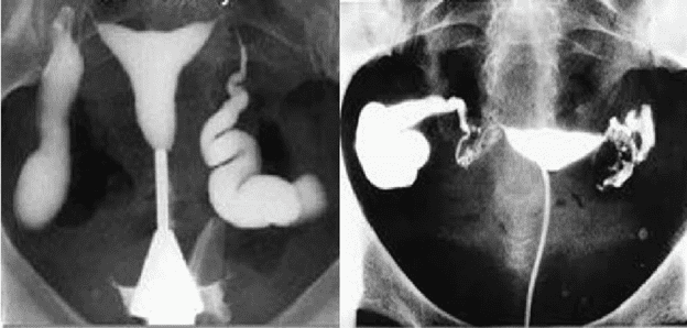 Mục đích của kỹ thuật chụp X-quang tử cung vòi trứng Mục đích của kỹ thuật chụp X-quang tử cung vòi trứng