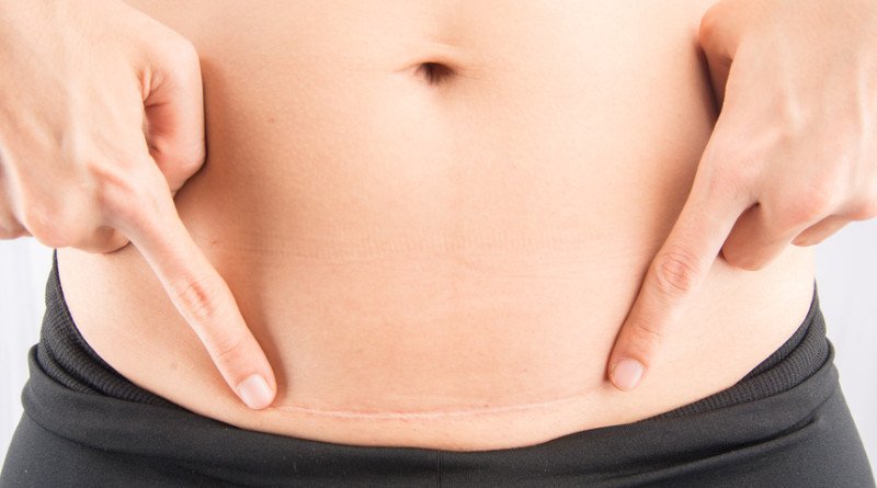 Chửa tại vết mổ đẻ cũ là gì? Chửa tại vết mổ cũ nguy hiểm như thế nào?